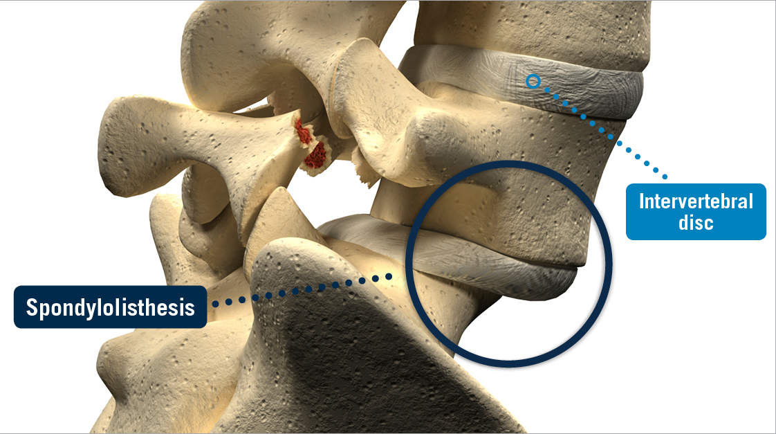 Spondylolisthesis