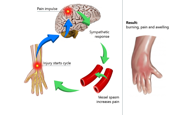 Complex Regional Pain Syndrome (CRPS)