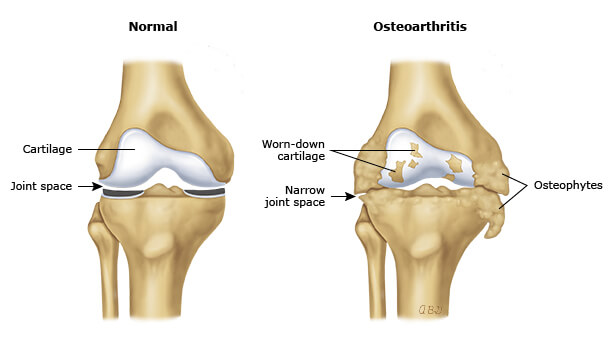 Degenerative Joint Disease