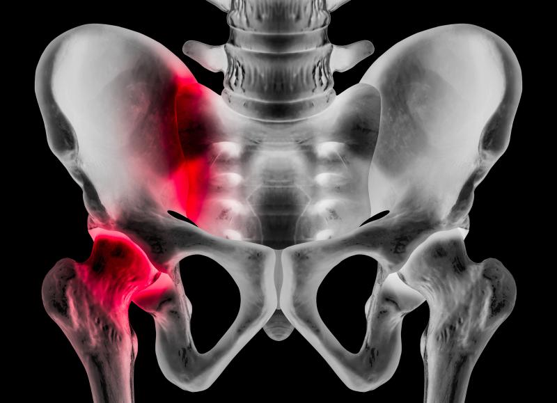 Hip Osteoarthritis