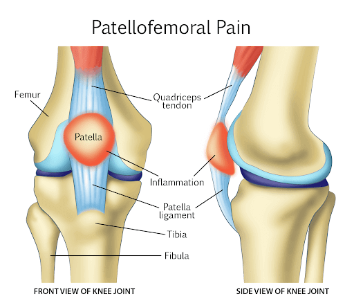 Knee Patellofemoral Pain Syndrome