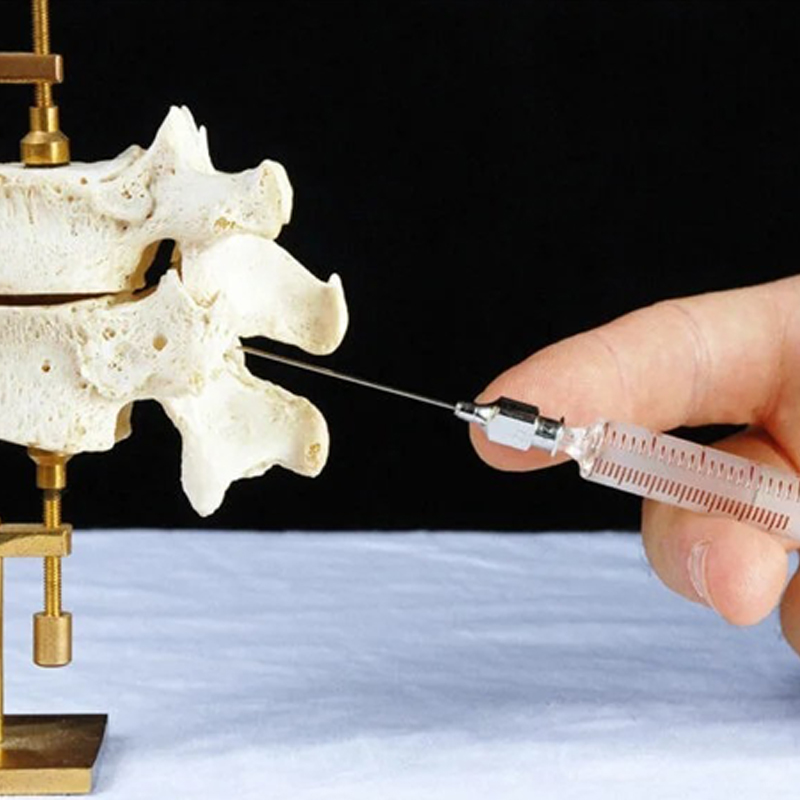 epidural steroid injection