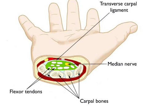 Carpal Tunnel Syndrome