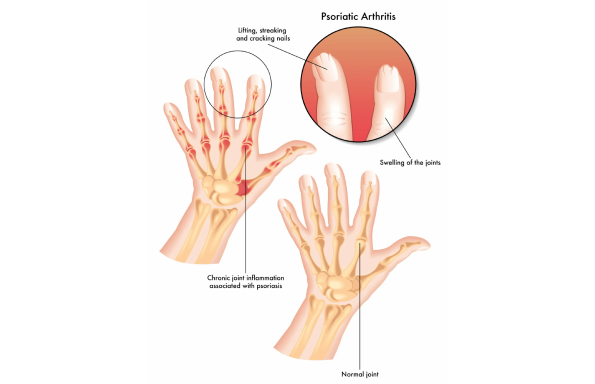 Psoriatic Arthritis