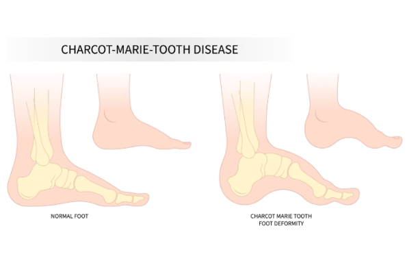 Charcot Marie Tooth Disease