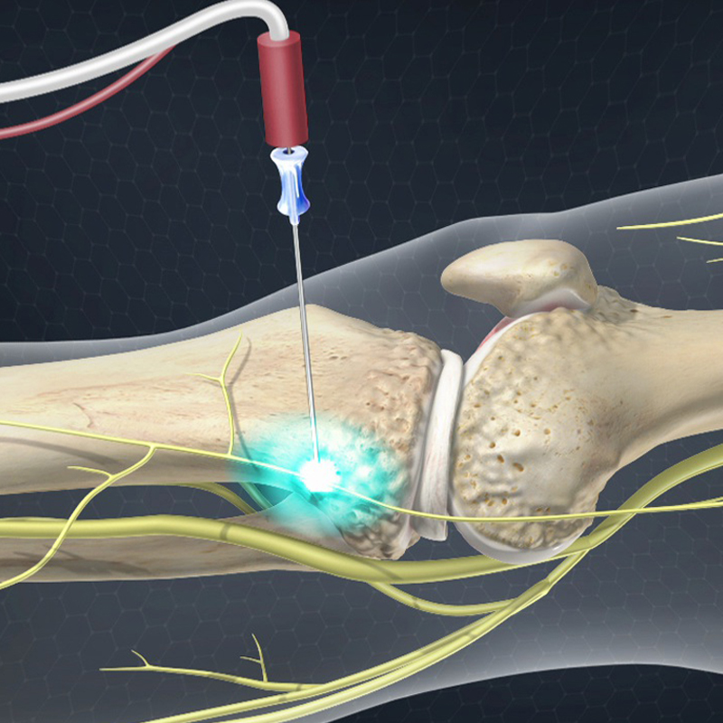 Genicular Nerve Ablation